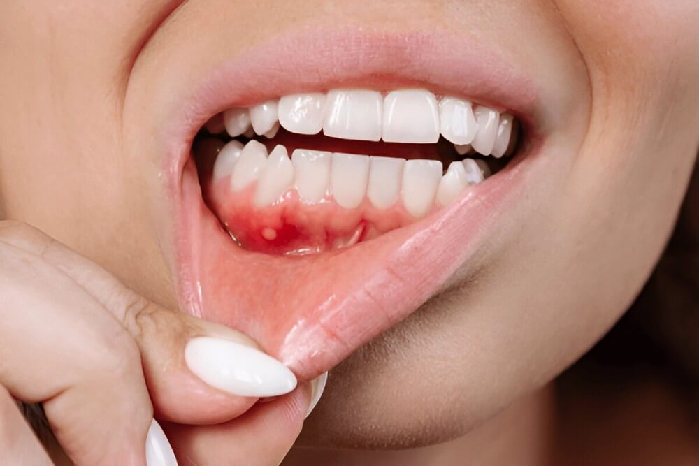 Are Gum Diseases Contagious Are Gum Diseases Contagious