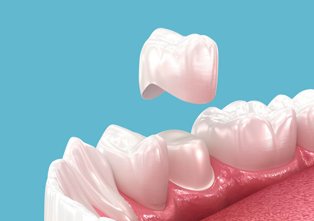Dental,Crown,Placement,Over,Tooth.,3d,Illustration Dental,Crown,Placement,Over,Tooth.,3d,Illustration