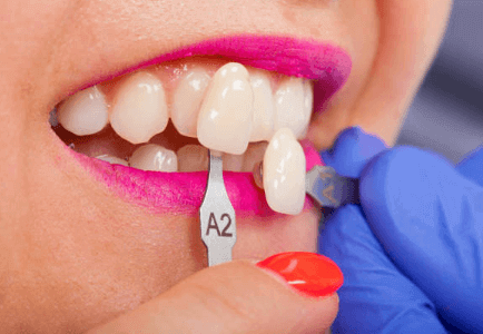 How Much Do Same-Day Crowns Cost in Westchase How Much Do Same-Day Crowns Cost in Westchase