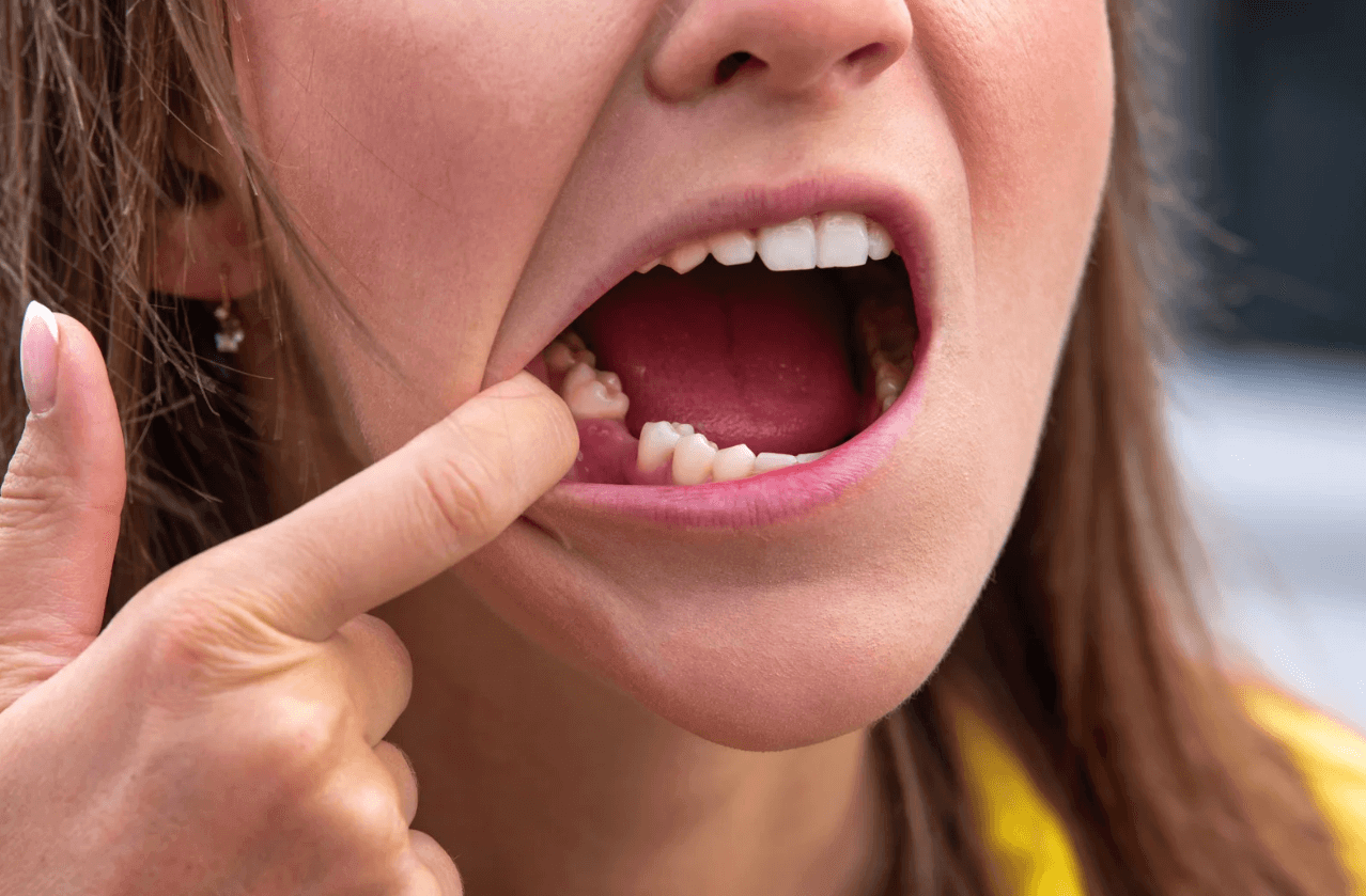 Tooth Extraction