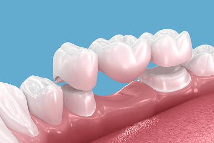 Dental Crowns vs. Veneers Dental Crowns vs. Veneers